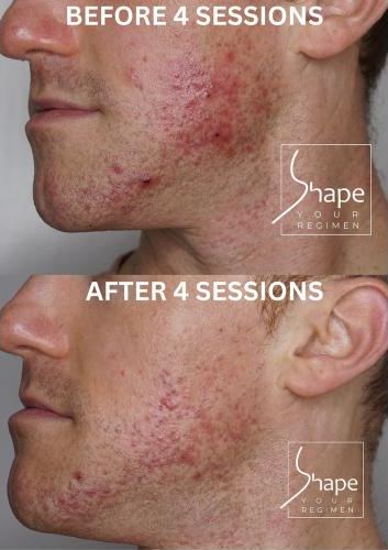 Acne before and after four sessions