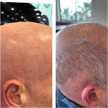 Crown before and after TargetCool® scalp treatment