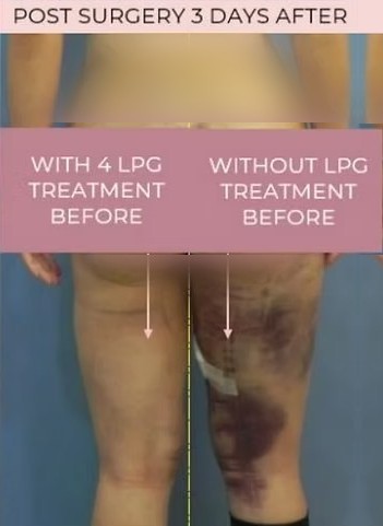 Liposuction recovery three days after surgery. The leg treated with four LPG sessions beforehand shows far less bruising than the untreated leg.
